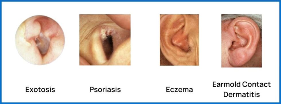 Common Conditions of the External Ear – Pacific Audiology Group